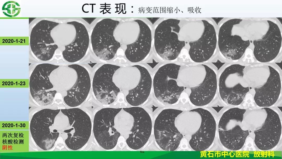 【PPT】新型冠状病毒（2019-nCoV）肺炎影像学表现病例分享