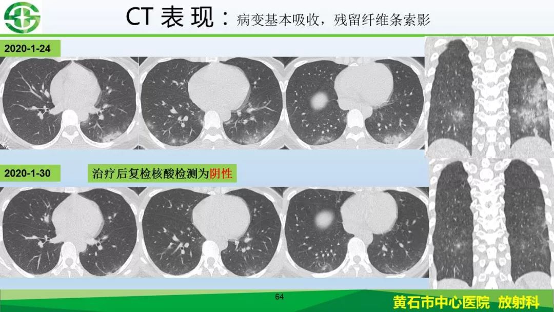 【PPT】新型冠状病毒（2019-nCoV）肺炎影像学表现病例分享