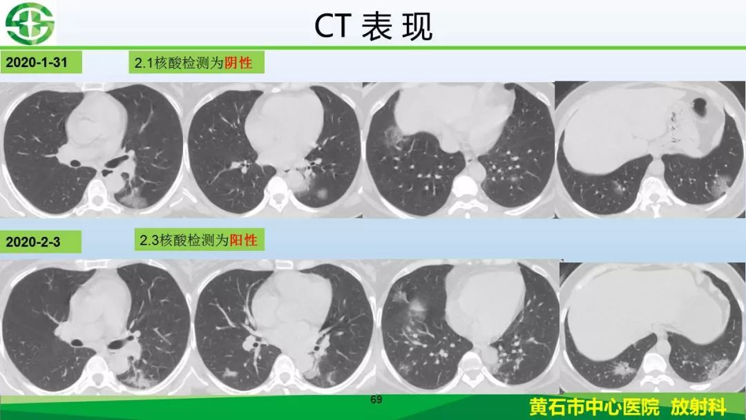 【PPT】新型冠状病毒（2019-nCoV）肺炎影像学表现病例分享
