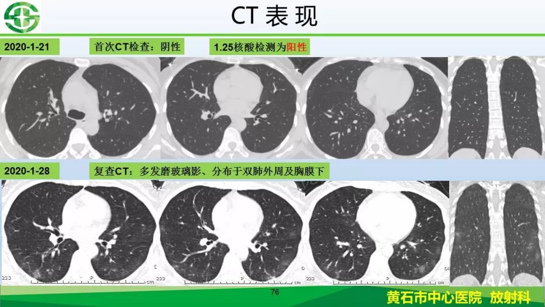 【PPT】新型冠状病毒（2019-nCoV）肺炎影像学表现病例分享