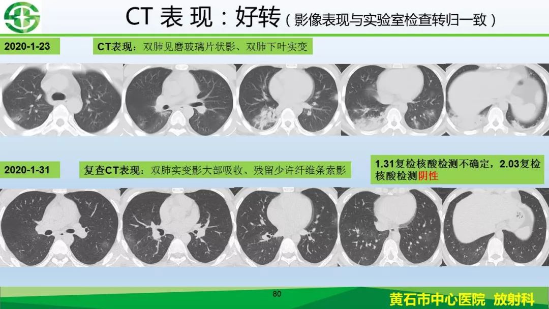 【PPT】新型冠状病毒（2019-nCoV）肺炎影像学表现病例分享