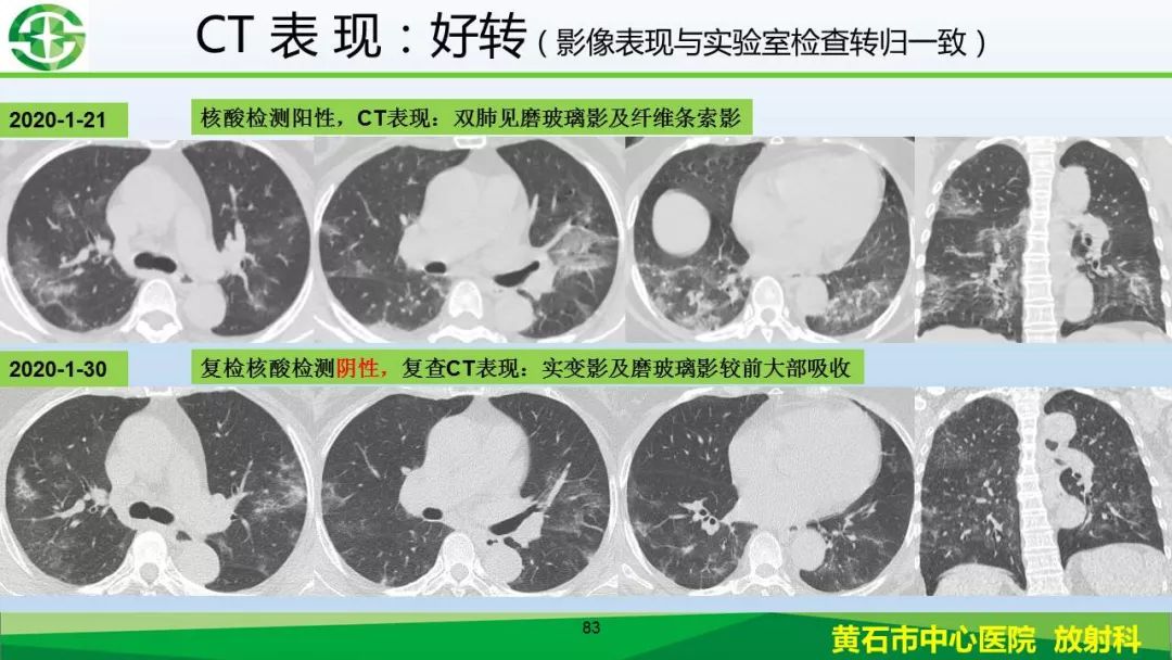 【PPT】新型冠状病毒（2019-nCoV）肺炎影像学表现病例分享