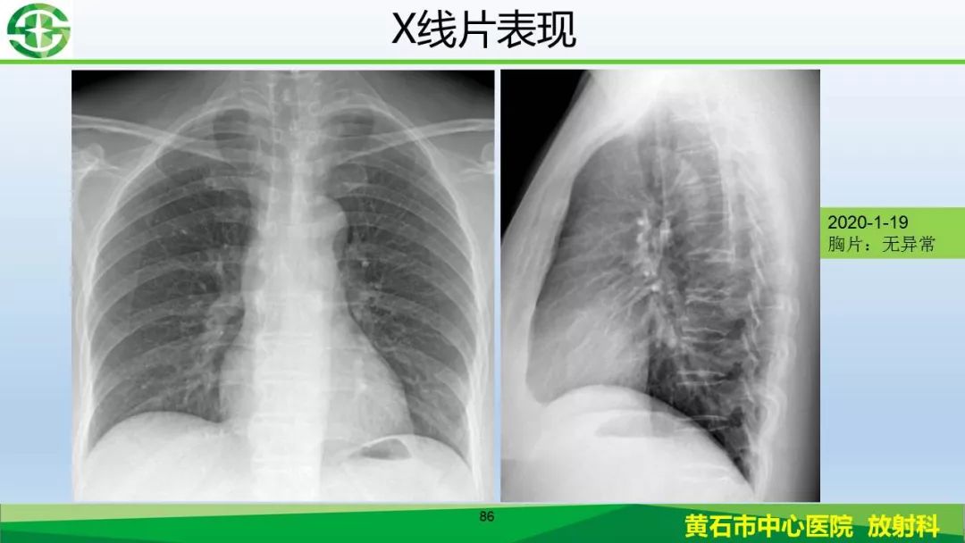【PPT】新型冠状病毒（2019-nCoV）肺炎影像学表现病例分享