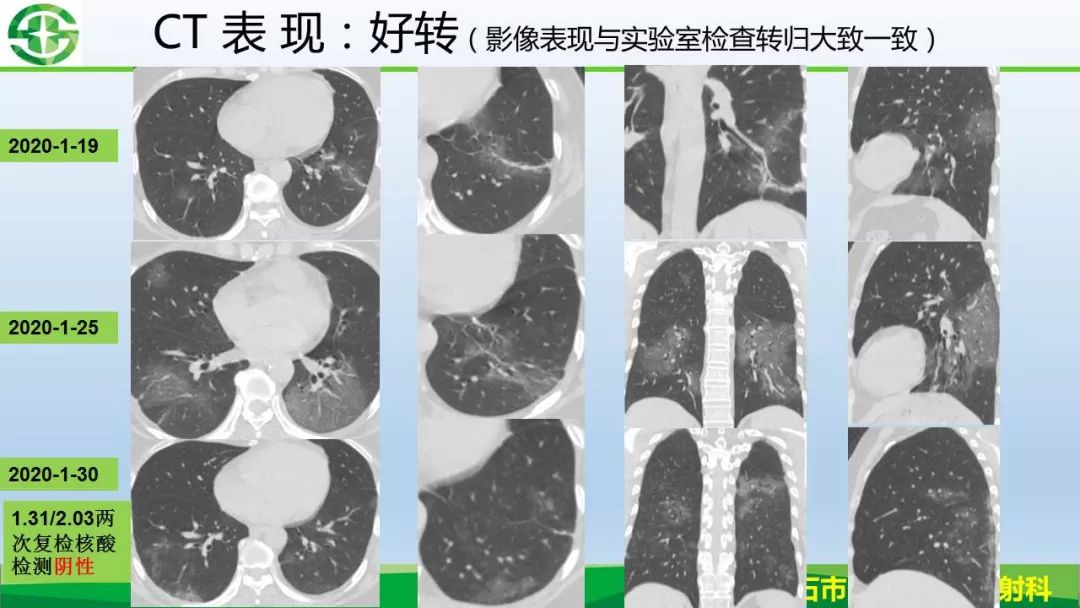 【PPT】新型冠状病毒（2019-nCoV）肺炎影像学表现病例分享