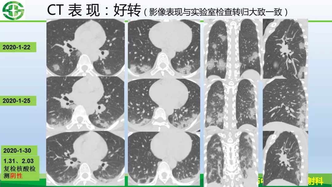 【PPT】新型冠状病毒（2019-nCoV）肺炎影像学表现病例分享