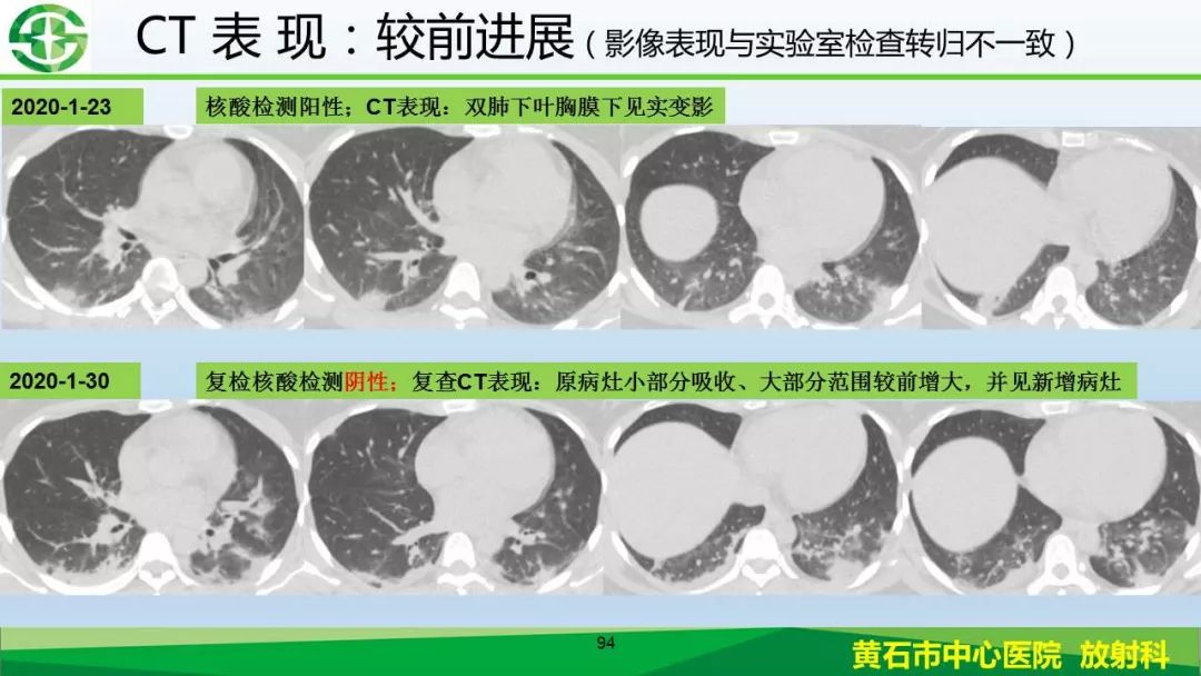 【PPT】新型冠状病毒（2019-nCoV）肺炎影像学表现病例分享