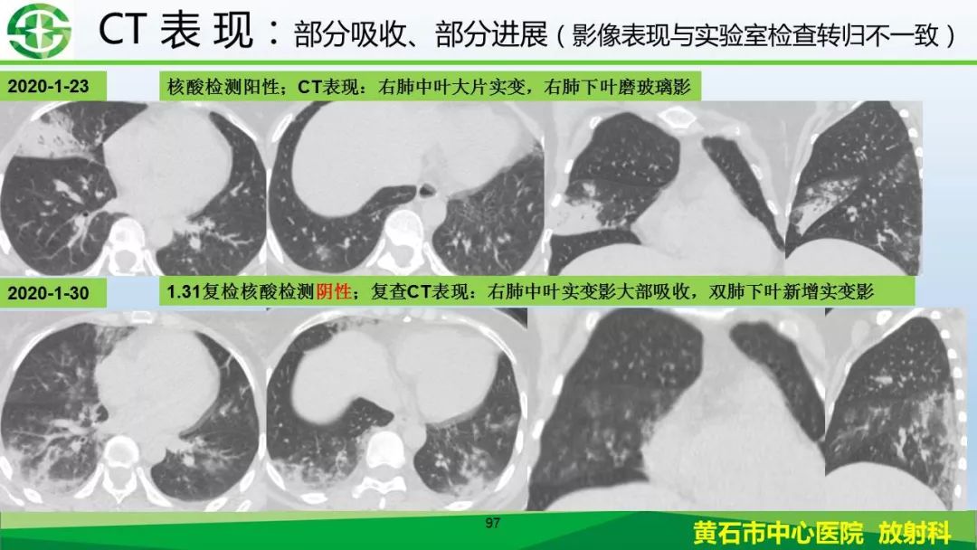【PPT】新型冠状病毒（2019-nCoV）肺炎影像学表现病例分享