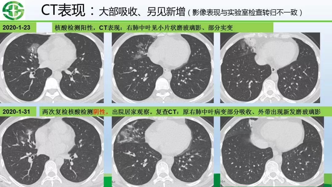 【PPT】新型冠状病毒（2019-nCoV）肺炎影像学表现病例分享