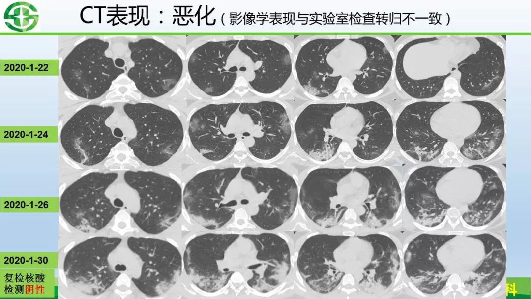 【PPT】新型冠状病毒（2019-nCoV）肺炎影像学表现病例分享