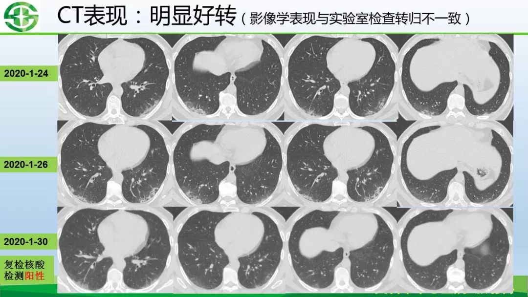 【PPT】新型冠状病毒（2019-nCoV）肺炎影像学表现病例分享