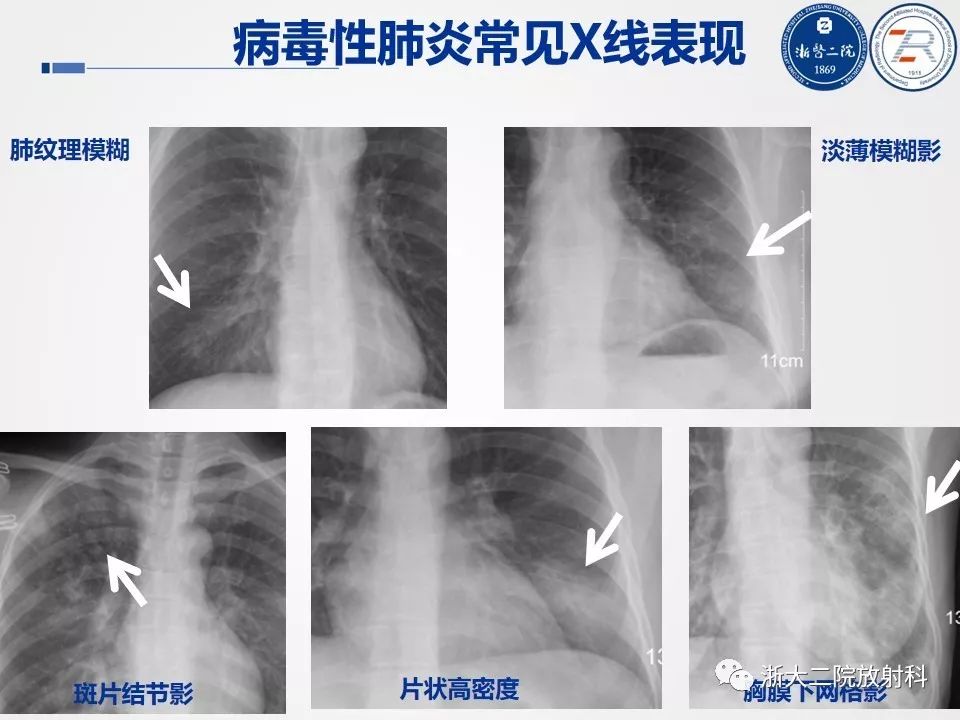 【PPT】新型冠状病毒肺炎影像学表现