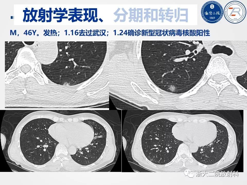 【PPT】新型冠状病毒肺炎影像学表现