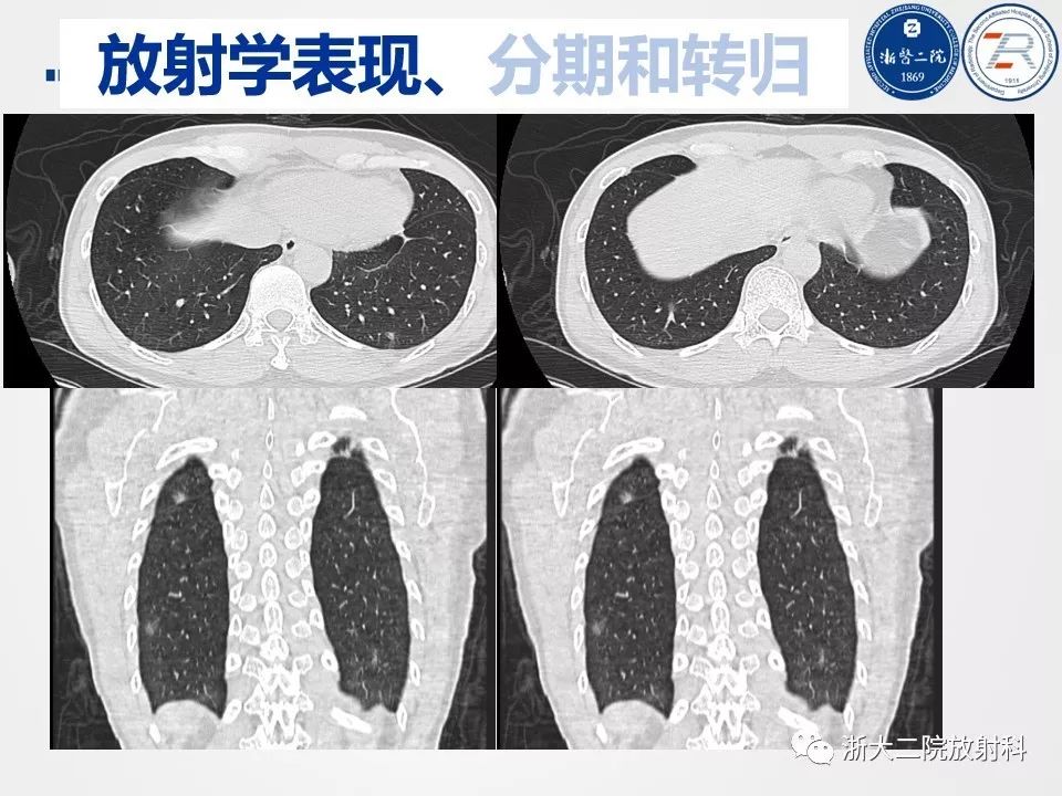 【PPT】新型冠状病毒肺炎影像学表现