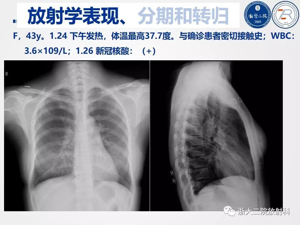 【PPT】新型冠状病毒肺炎影像学表现