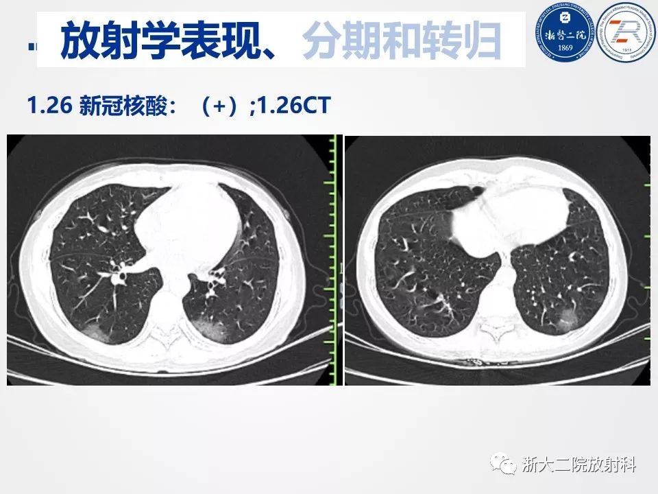 【PPT】新型冠状病毒肺炎影像学表现