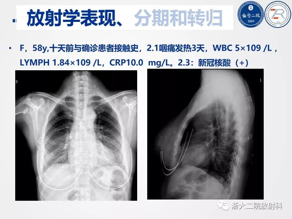 【PPT】新型冠状病毒肺炎影像学表现