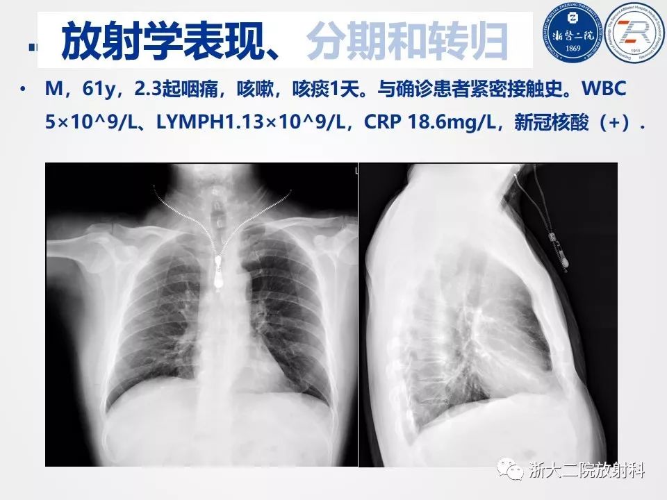 【PPT】新型冠状病毒肺炎影像学表现