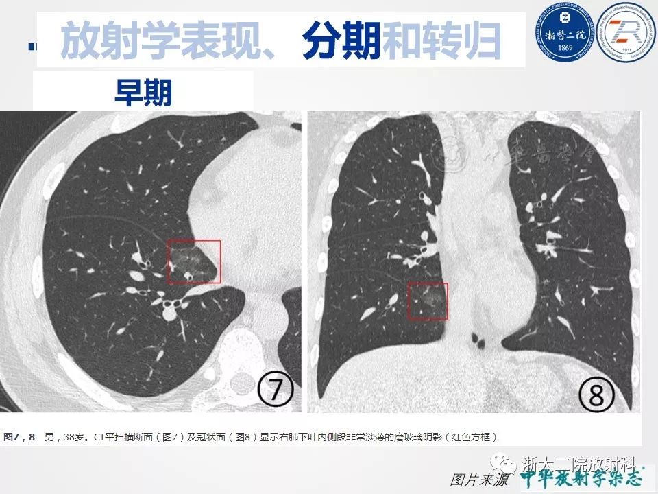 【PPT】新型冠状病毒肺炎影像学表现