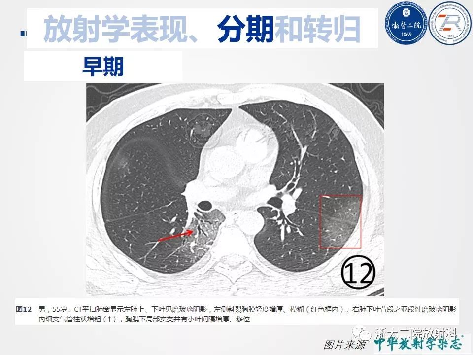 【PPT】新型冠状病毒肺炎影像学表现