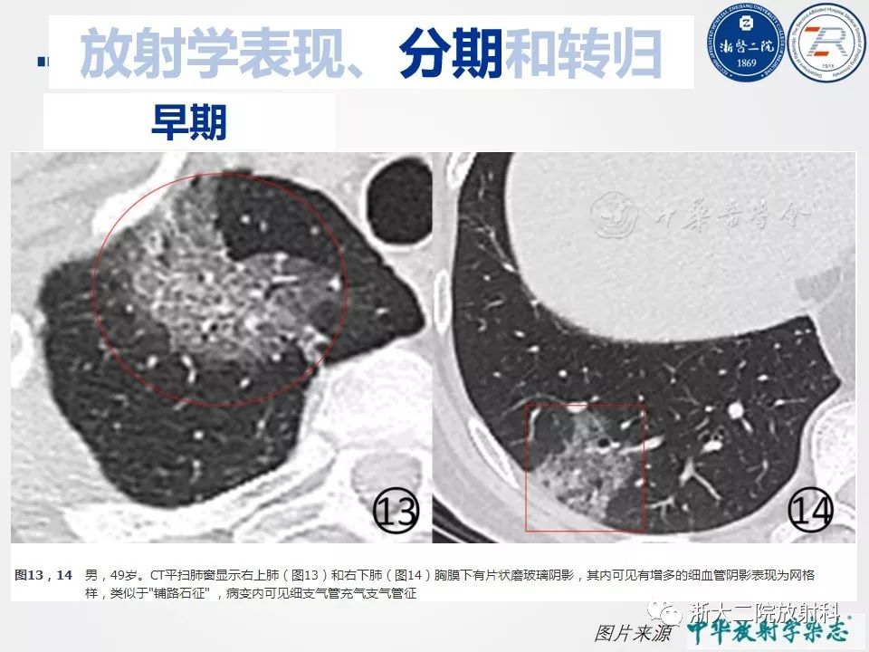【PPT】新型冠状病毒肺炎影像学表现