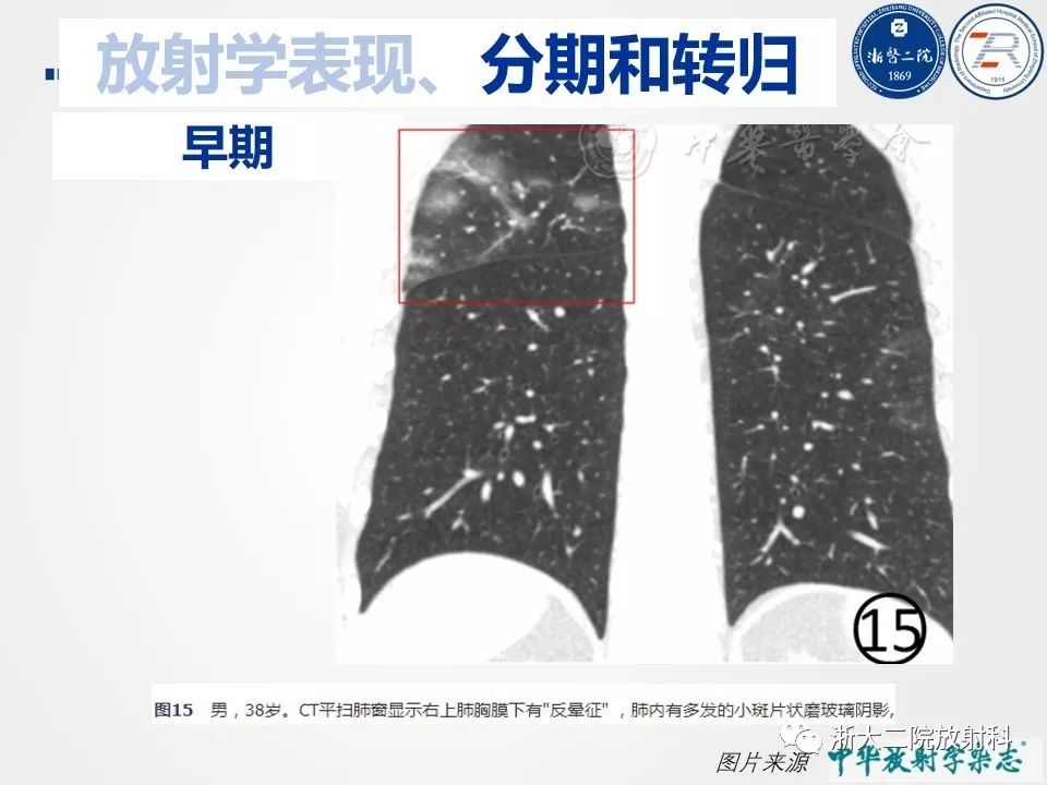 【PPT】新型冠状病毒肺炎影像学表现