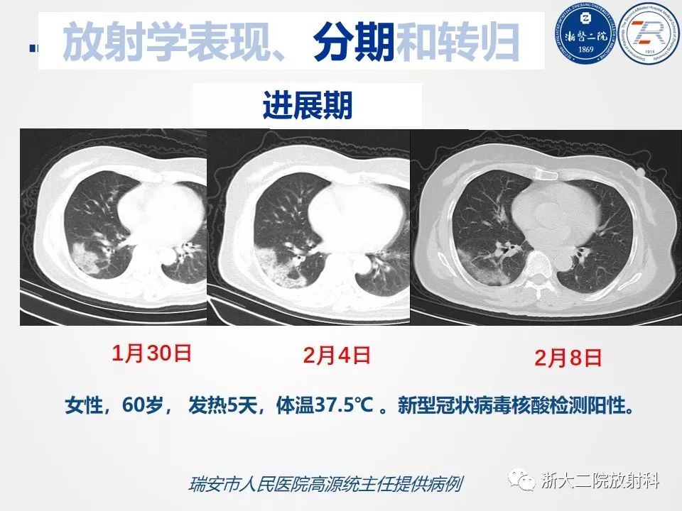 【PPT】新型冠状病毒肺炎影像学表现