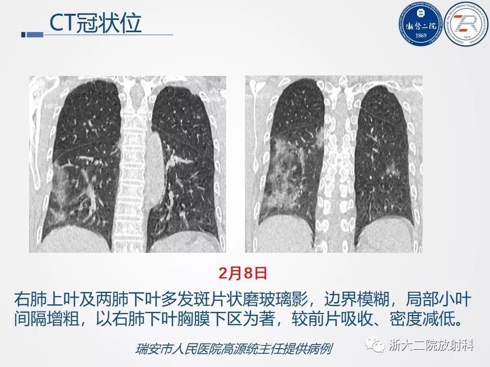 【PPT】新型冠状病毒肺炎影像学表现