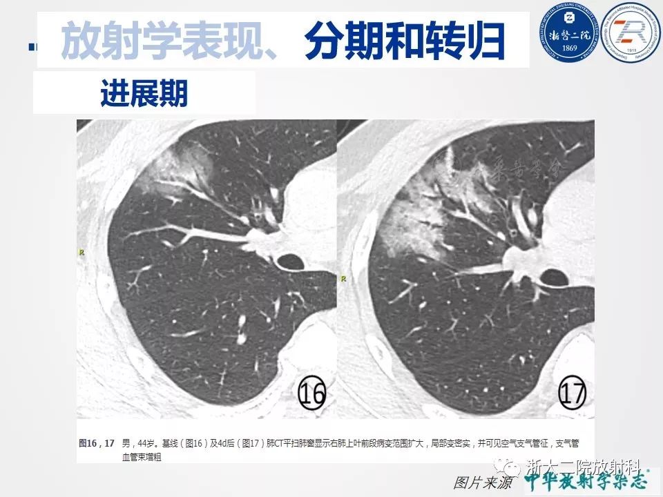 【PPT】新型冠状病毒肺炎影像学表现