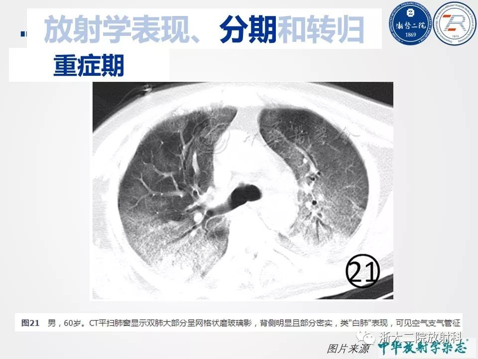 【PPT】新型冠状病毒肺炎影像学表现