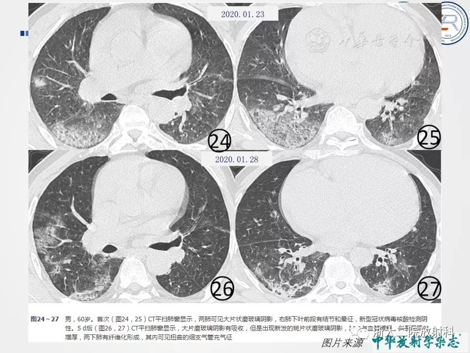 【PPT】新型冠状病毒肺炎影像学表现
