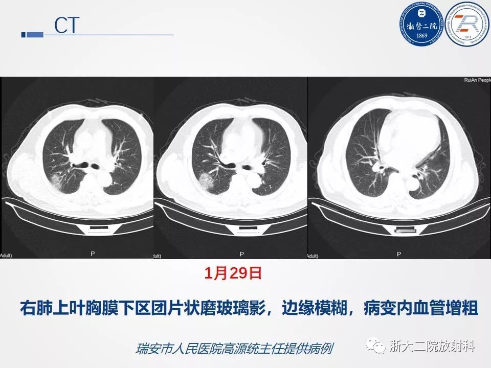 【PPT】新型冠状病毒肺炎影像学表现
