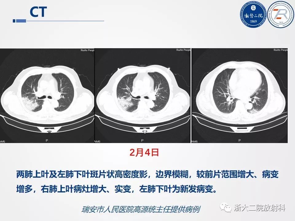 【PPT】新型冠状病毒肺炎影像学表现