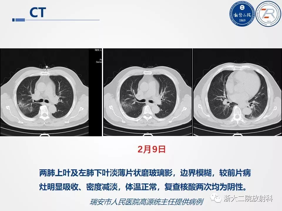 【PPT】新型冠状病毒肺炎影像学表现