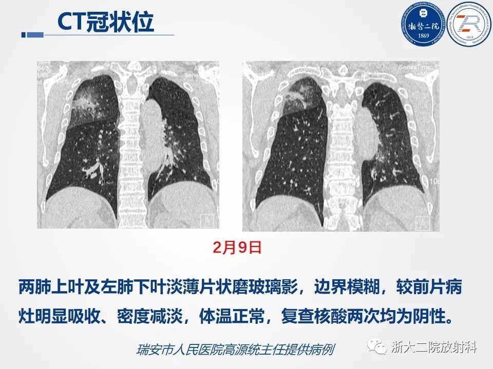 【PPT】新型冠状病毒肺炎影像学表现