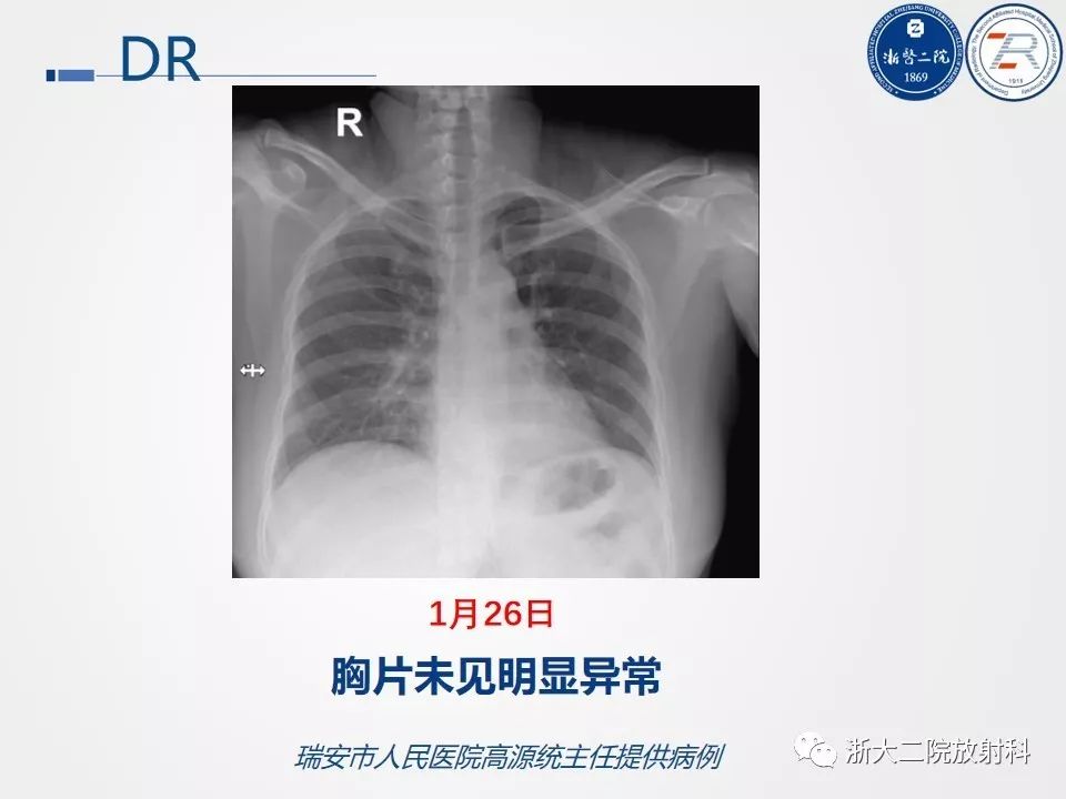 【PPT】新型冠状病毒肺炎影像学表现