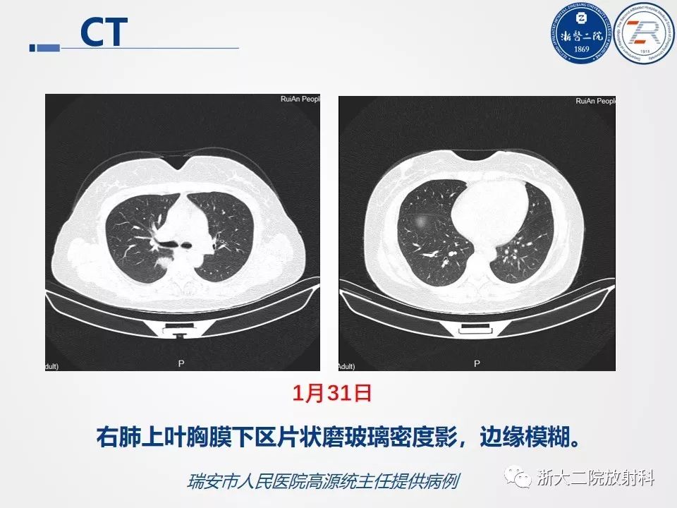 【PPT】新型冠状病毒肺炎影像学表现