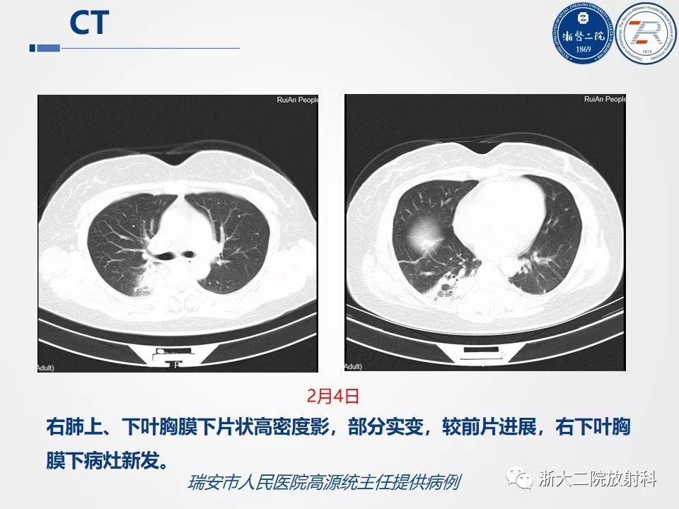 【PPT】新型冠状病毒肺炎影像学表现