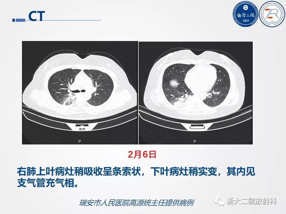【PPT】新型冠状病毒肺炎影像学表现