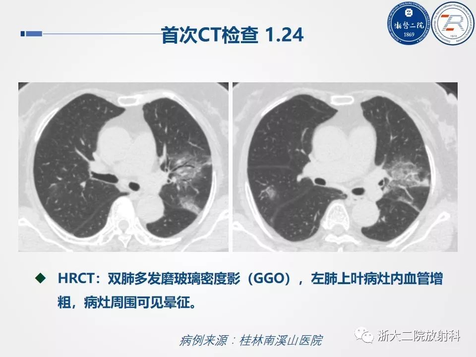 【PPT】新型冠状病毒肺炎影像学表现