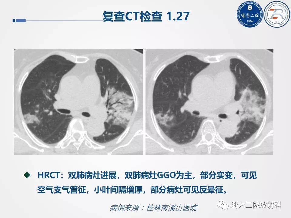 【PPT】新型冠状病毒肺炎影像学表现