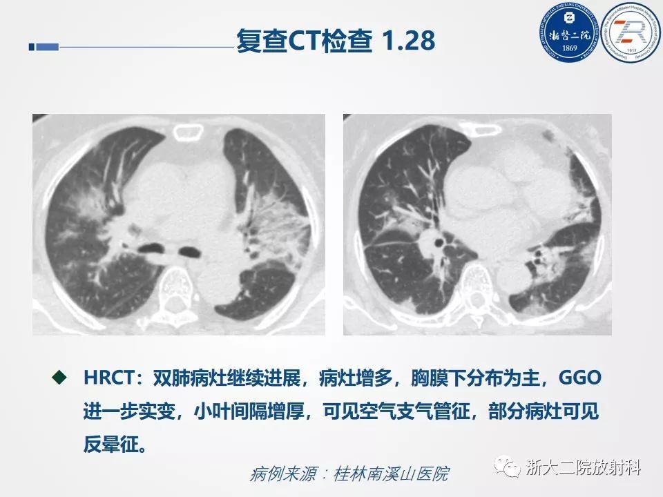 【PPT】新型冠状病毒肺炎影像学表现