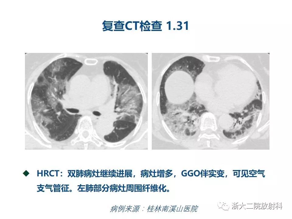 【PPT】新型冠状病毒肺炎影像学表现
