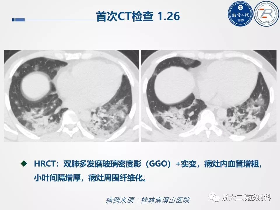 【PPT】新型冠状病毒肺炎影像学表现