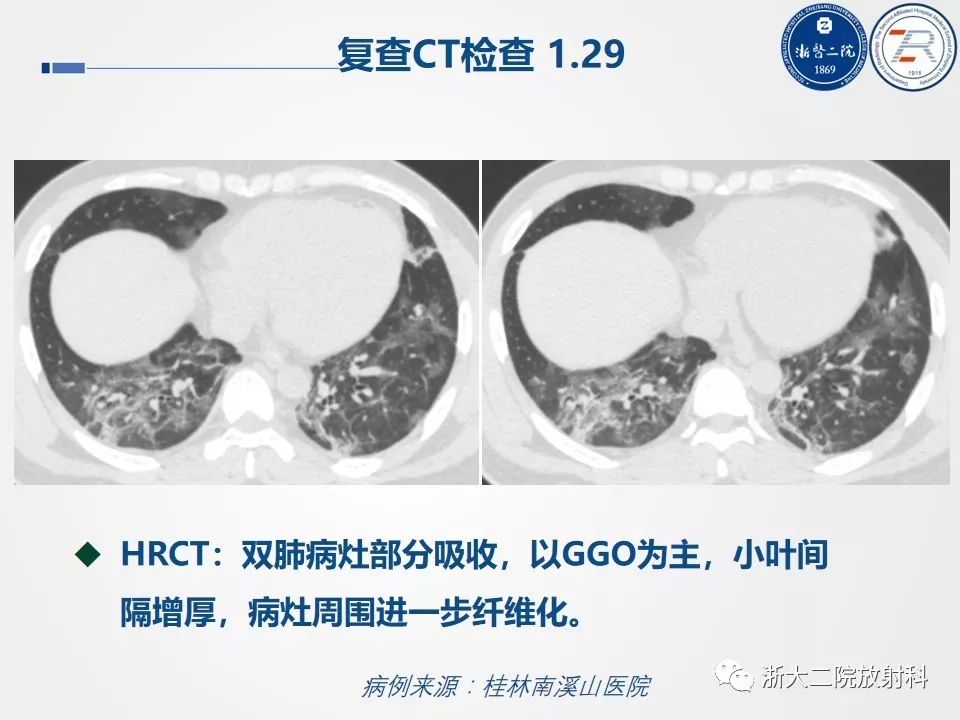 【PPT】新型冠状病毒肺炎影像学表现