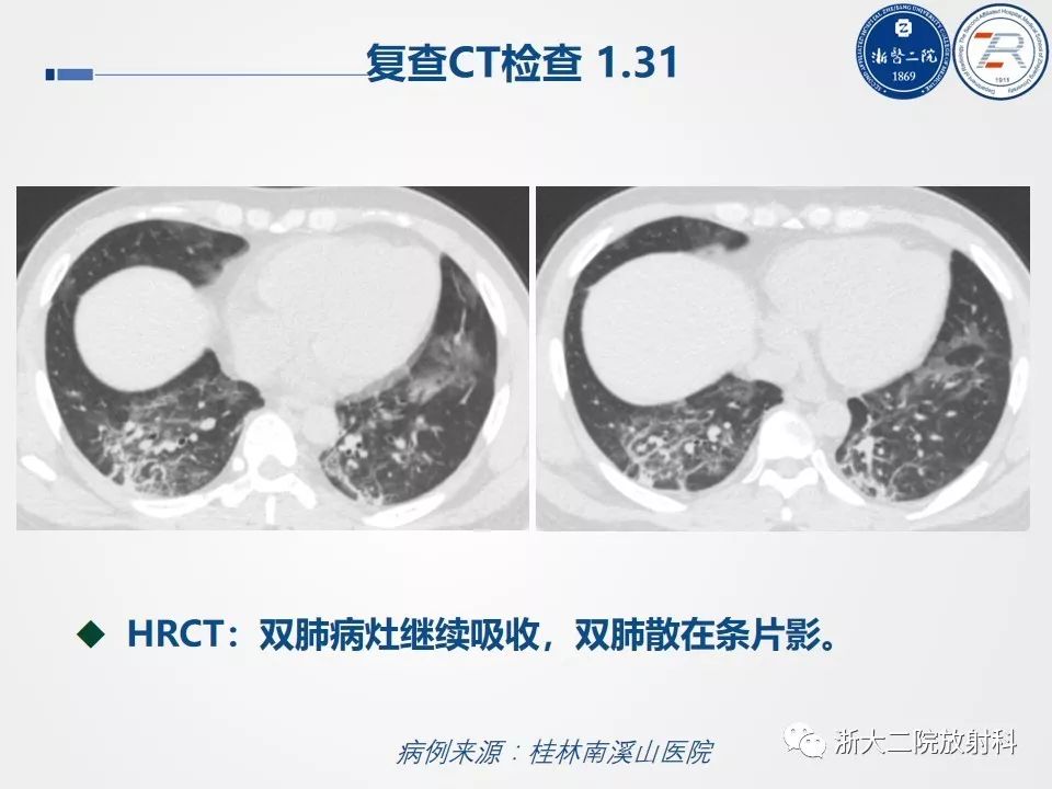【PPT】新型冠状病毒肺炎影像学表现