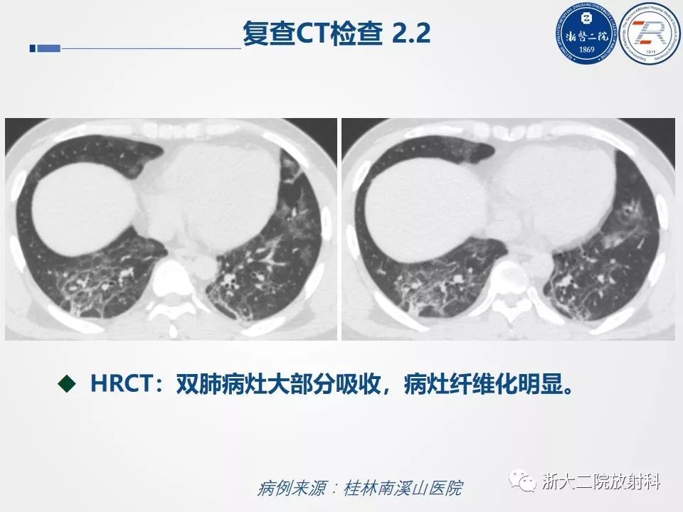 【PPT】新型冠状病毒肺炎影像学表现