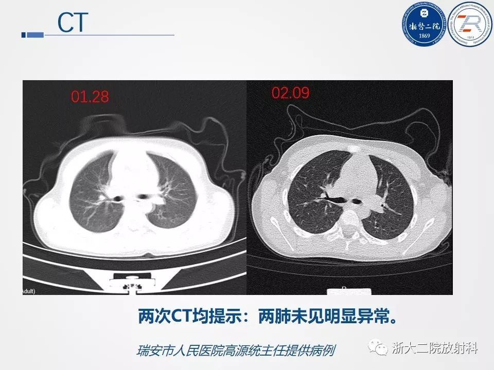 【PPT】新型冠状病毒肺炎影像学表现