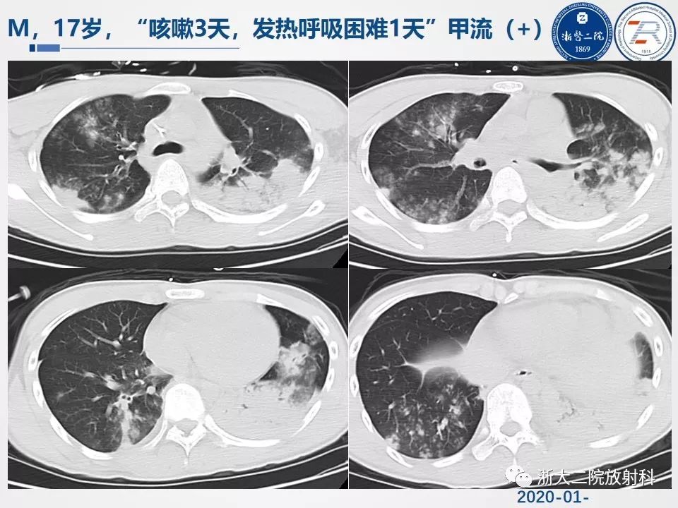 【PPT】新型冠状病毒肺炎影像学表现