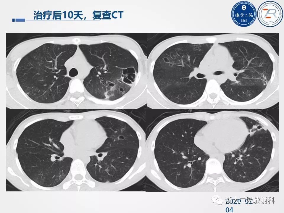 【PPT】新型冠状病毒肺炎影像学表现