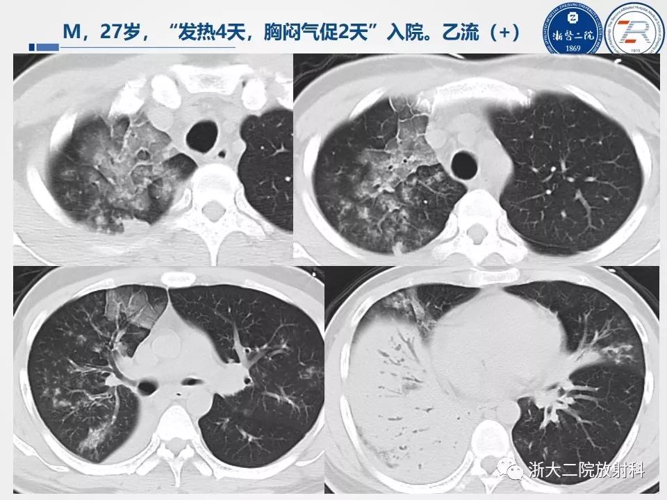 【PPT】新型冠状病毒肺炎影像学表现